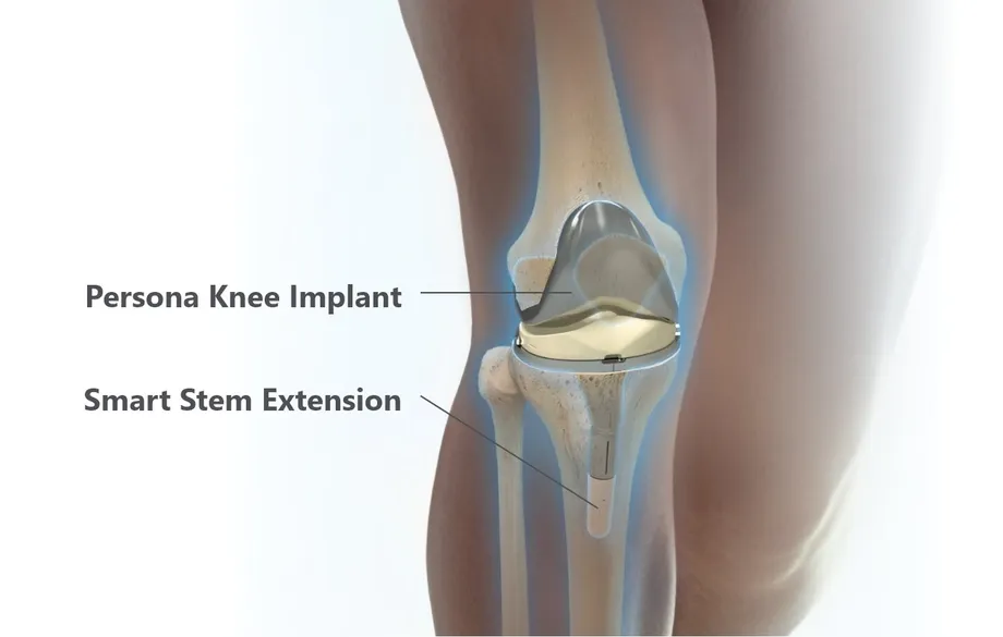Illustration of the Persona knee implant with the smart stem extension in the shinbone